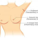 Implant incisions & placement