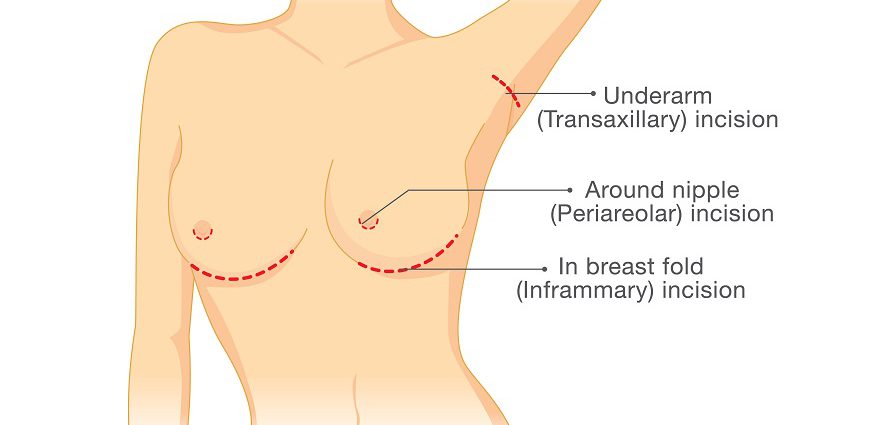 Implant incisions & placement