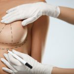 doctor marking patient breast for surgical incisions