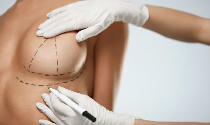 doctor marking patient breast for surgical incisions