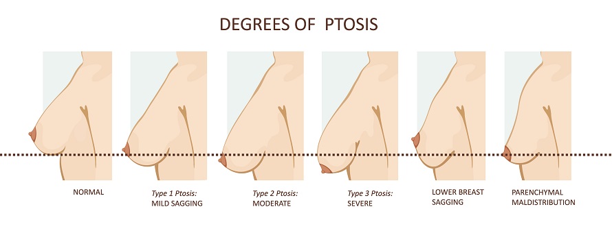 Laser Bra Breast Surgery - What Is It? Right For You? Cost Info