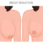 illustration showing before and after breast reduction surgery