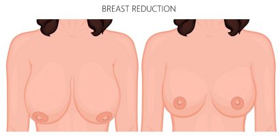 illustration showing before and after breast reduction surgery