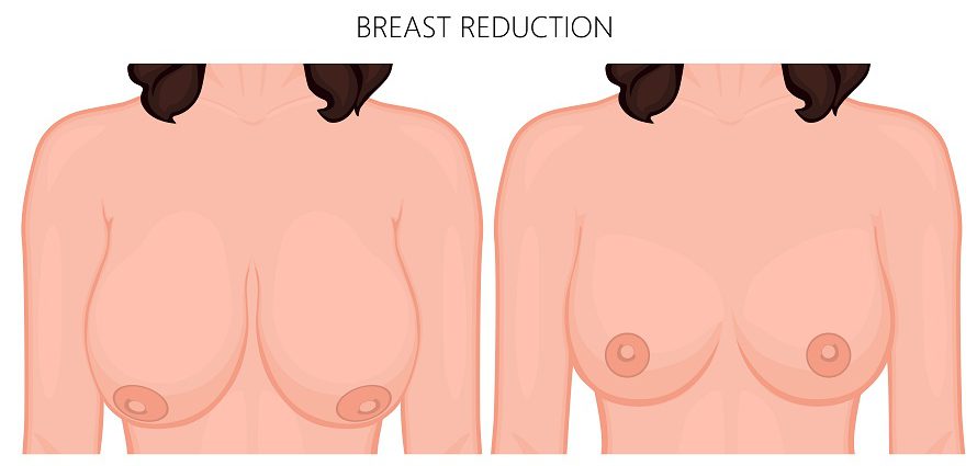 illustration showing before and after breast reduction surgery