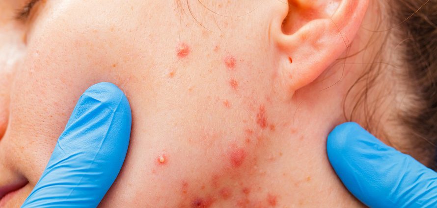 female acne patient with an outbreak of acne