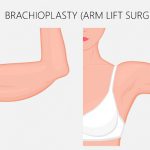 illustration showing the before and after results of arm lift surgery