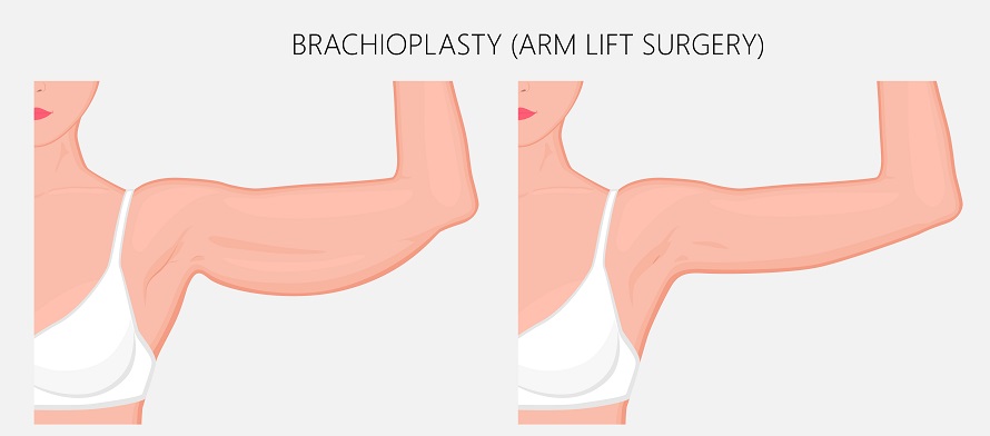 illustration showing the before and after results of arm lift surgery