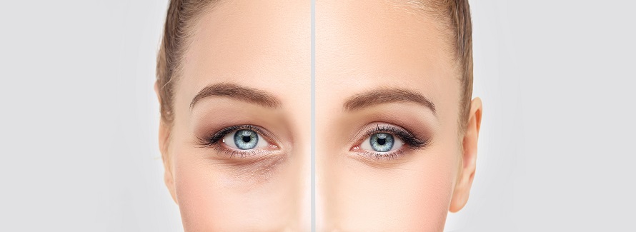 split image showing the results of eyelid surgery