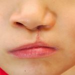 young child with repaired cleft palate