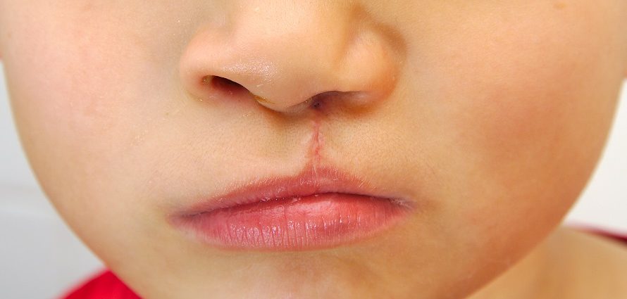 young child with repaired cleft palate