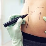 doctor marking a patient's abdomen to prepare for treatment