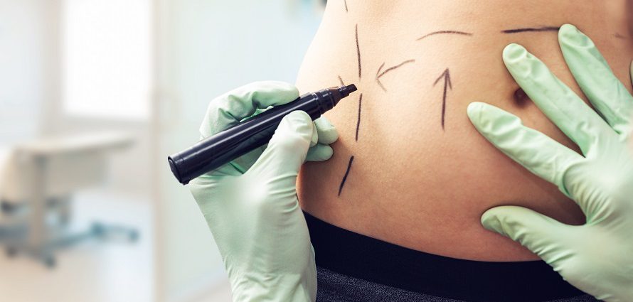 doctor marking a patient's abdomen to prepare for treatment