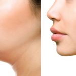 female patient before and after facial liposuction