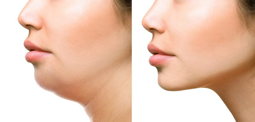 female patient before and after facial liposuction