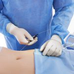 plastic surgeon performing liposuction on patient