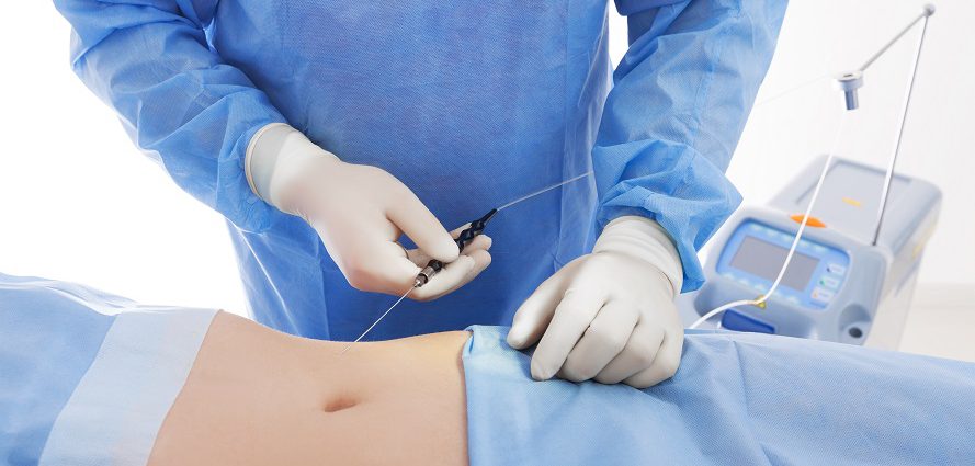 plastic surgeon performing liposuction on patient