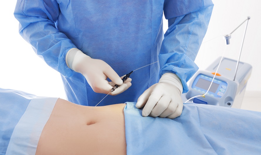 Laser Liposuction Smartlipo Is It Worth The Money