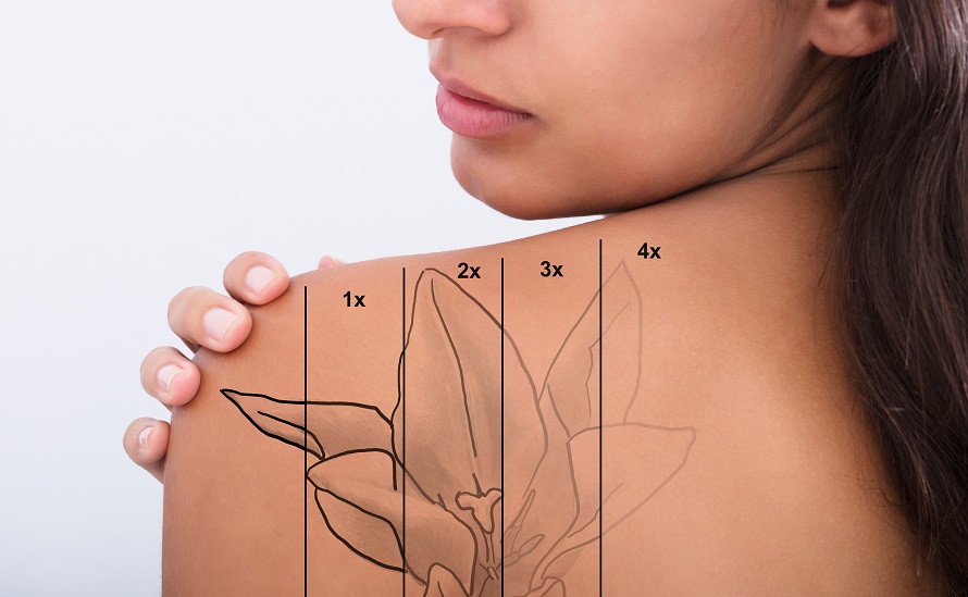 Tattoo Removal with PicoSure  Laser Tattoo Removal NYC