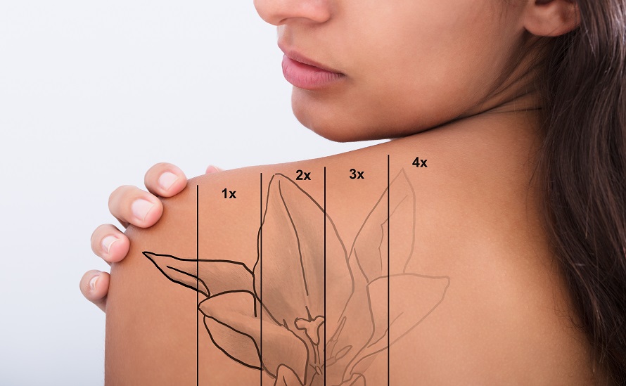 FEARLESS TATTOO REMOVAL  Laser Tattoo removal  Minnesota