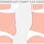 illustration showing a before and after tummy tuck comparison