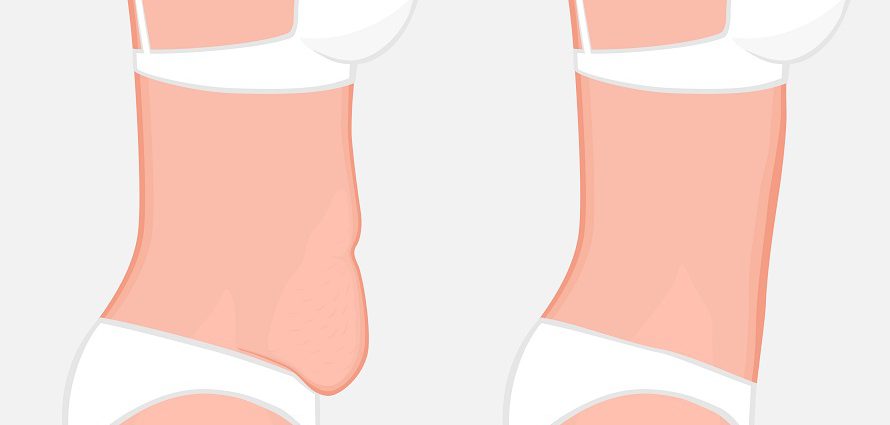 illustration showing a before and after tummy tuck comparison