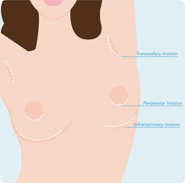 Breast Augmentation Incision Techniques: Areolar vs. Inframammary!