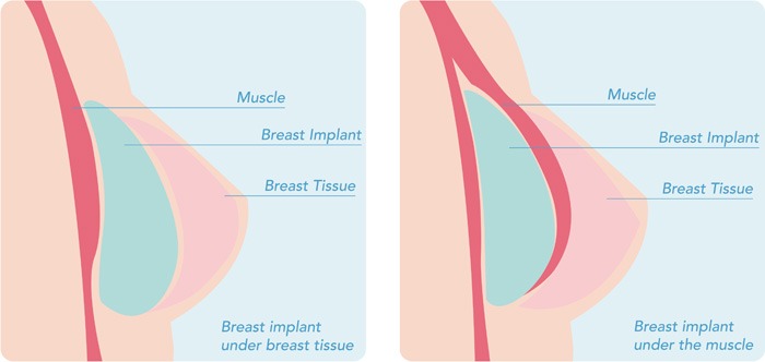 Breast Augmentation Sub muscular IMF Incision 